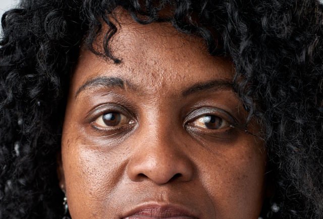 African American woman with under-eye dark circles
