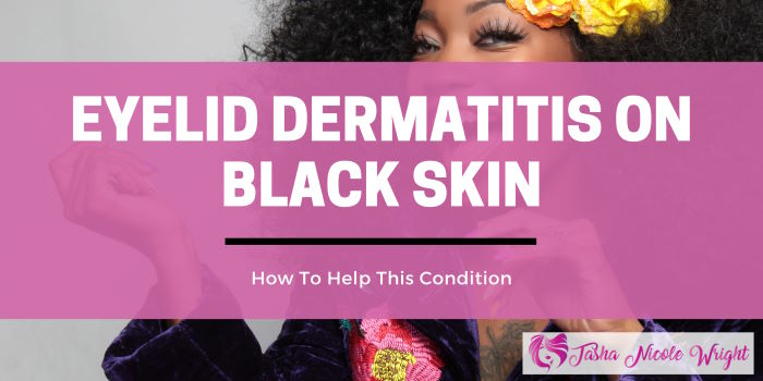 Eyelid Dermatits on Black Skin